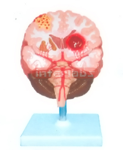 BRAIN STROKE DEMONSTRATION MODEL